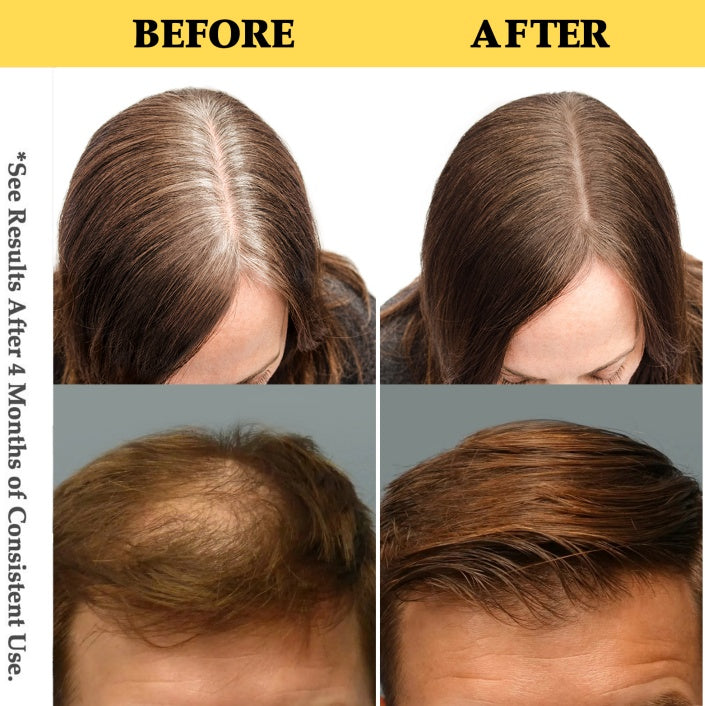 Natural Hair Growth Oil Spray - Battana Rosemary Serum Biotin Caffeine Scalp Treatment - Thinning Hair Regrowth And Thickening For Women And Men-It Is Forbidden To Sell On The TikTok Platform